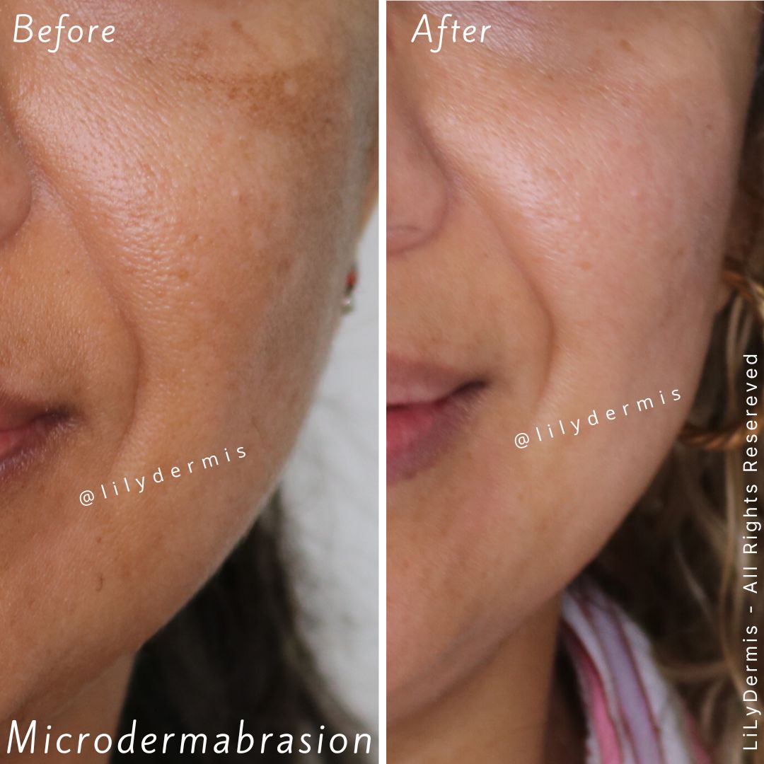 Microdermabrasion